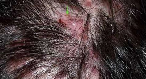Clogged Hair Follicles On Scalp Face Legs Causes And Remedies Treat