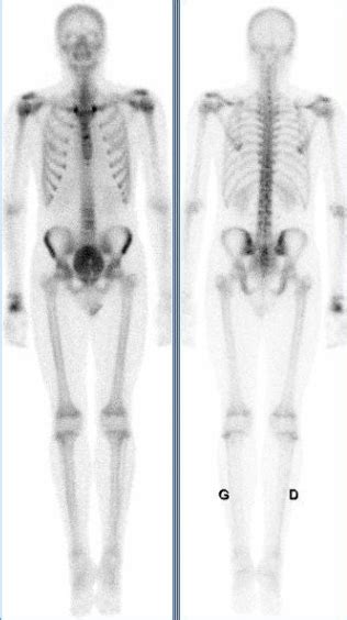 La revue de médecine interne 37(1). Ostéonécrose post traumatique du capitatum - Mednuc.net