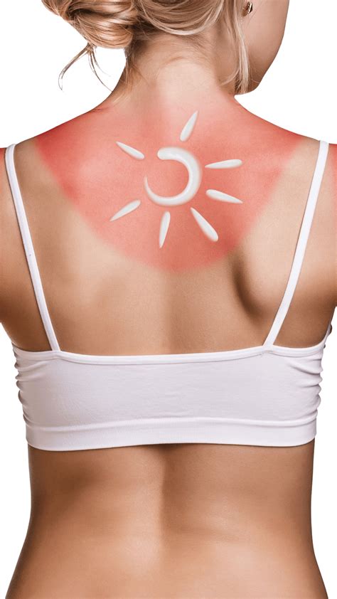 Arsurile Solare Cauze Simptome Si Tratament Repere Medicale My Xxx Hot Girl