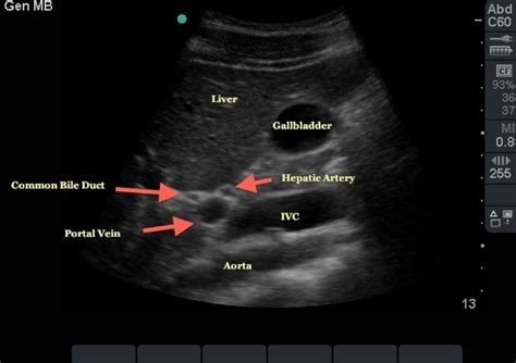 Biliary Ultrasound Core Em