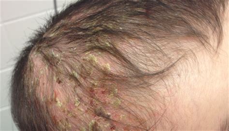 Derm Dx Worsening Scalp Axillae Rash In An Infant Clinical Advisor