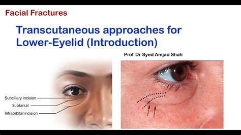 Transcutaneous Approaches For Lower Eyelid Oral And Maxillofacial Surgery Syed Amjad Shah