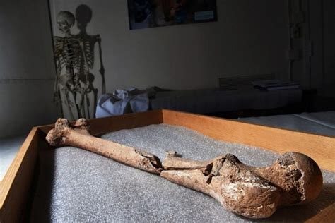Bones Of Civil War Amputees Found In Limb Pit
