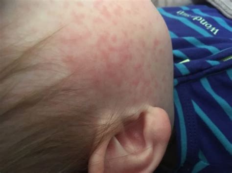 Signs Of Allergic Reaction To Amoxicillin In Babies