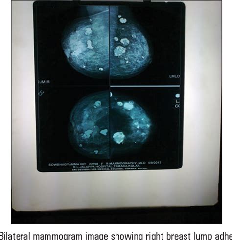 Figure 1 From Bilateral And Multifocal Phyllodes Tumors With