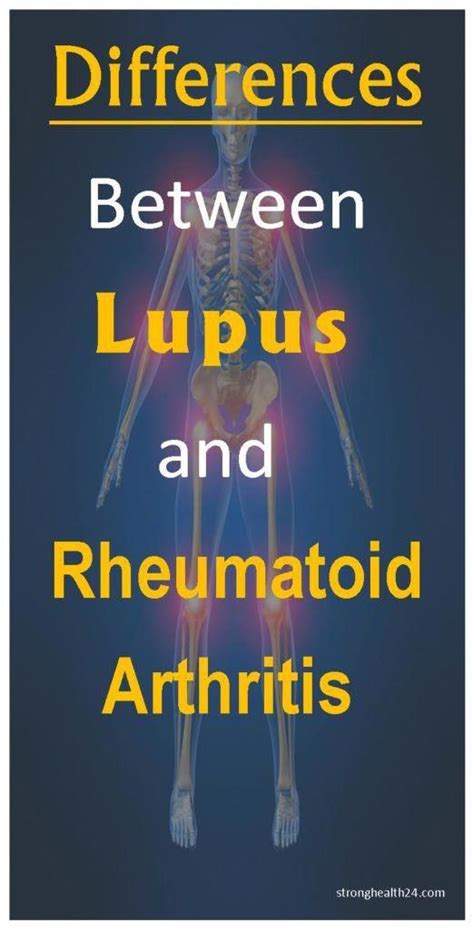 Differences Between Lupus And Rheumatoid Arthritis Stronghealth24