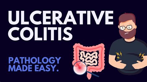 Ulcerative Colitis I Pathology Made Easy Youtube