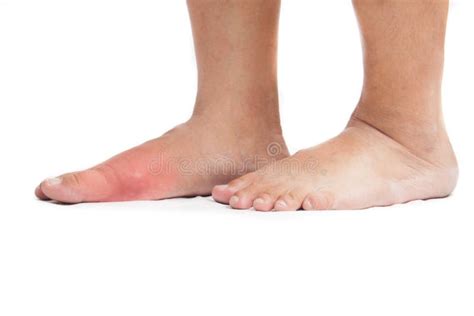 Inflammation De Goutte Sur Le Pied Droit Image Stock Image Du Goutte