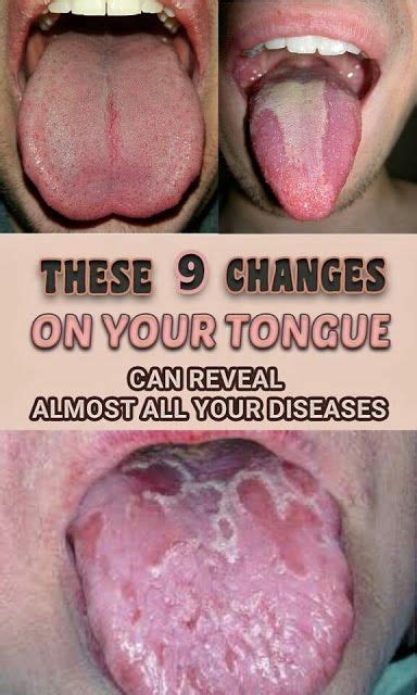 Be Aware Of This These 9 Changes On Your Tongue Reveal Almost All Your