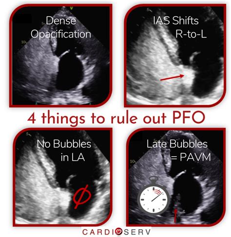 4 Things Needed To Rule Out A Patent Foramen Ovale Pfo Cardioserv