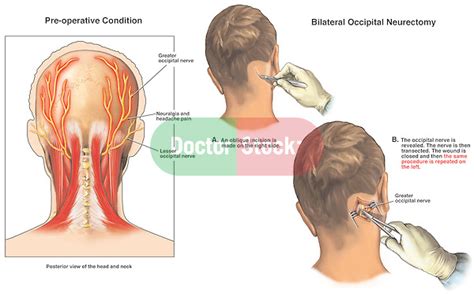 Occipital Neuralgia With Surgical Neurectomies Doctor Stock