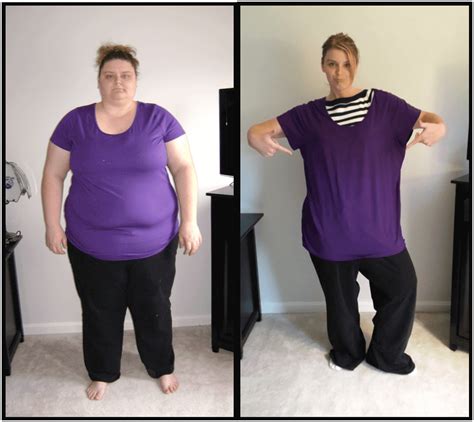 Gastric Bypass Before And After Pictures How Life Will Change