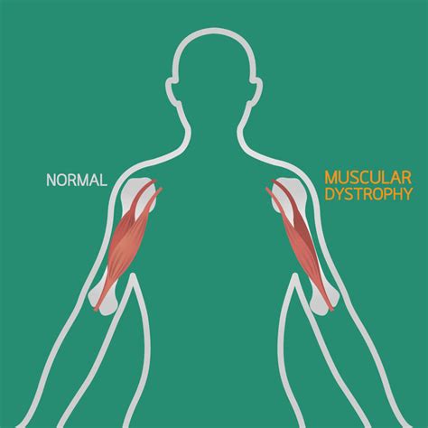 What Is Muscular Dystrophy And How Does Muscle Therapy Help