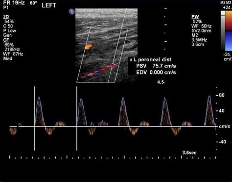 Leg Arterial Normal Ultrasoundpaedia