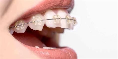 Top 19 How Much Do Braces Cost 2023