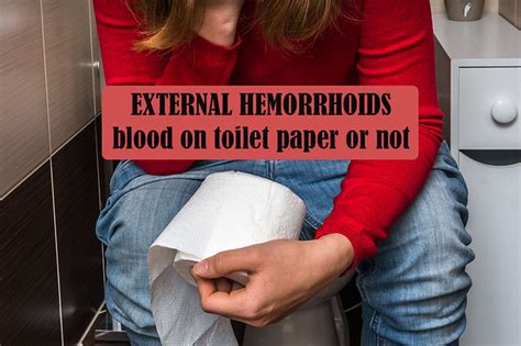 External Hemorrhoids Blood On Toilet Paper Or Not Flickr