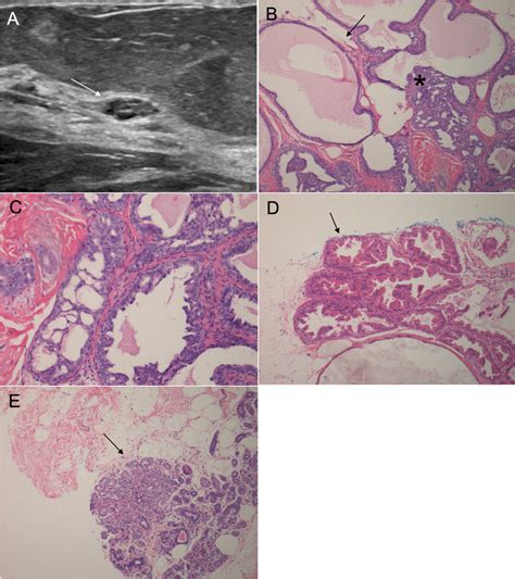 Fibrocystic Change A Targeted Breast Ultrasound A In A 54 Year Old