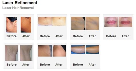 But with our technology, it's made easy smooth pulse pro laser hair removal by the german laser technology pioneers, asclepion, is there are currently bhrc medical spas in a number of locations across the u.s.: Los Angeles Laser Hair Removal