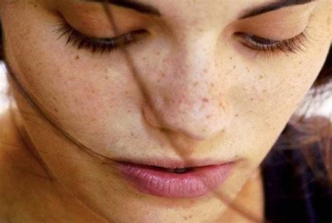 Brown Spots On The Face Are A Common Aesthetic Issue That Affects Both