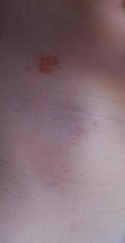 What Is The Difference Between Petechiae And Purpura