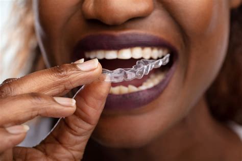 How Much Does Invisalign Cost In The Uk