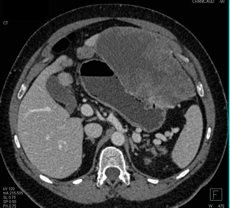 Large Exophytic Gastric Gist Tumor Stomach Case Studies Ctisus Ct