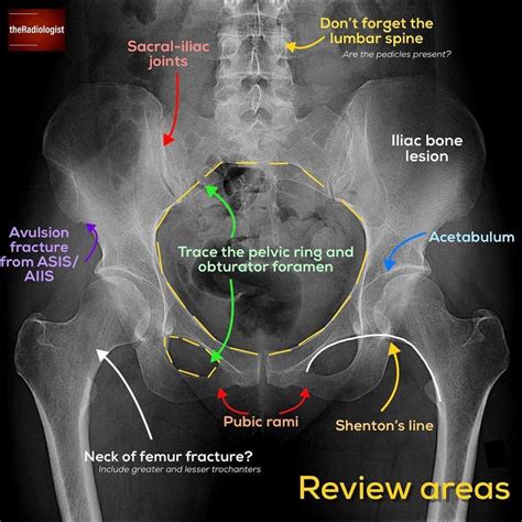 👨🏽‍💻want To Learn A System For Reviewing A Pelvic X Ray ⁣ ⁣ 👨🏽‍💻the