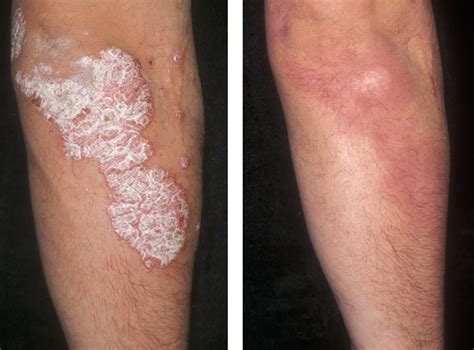 What Is Psoriasis And Why Should I Care About It Crutchfield Dermatology