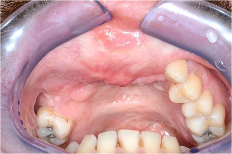Microvascular Reconstruction And Dental Rehabilitation Of Benign