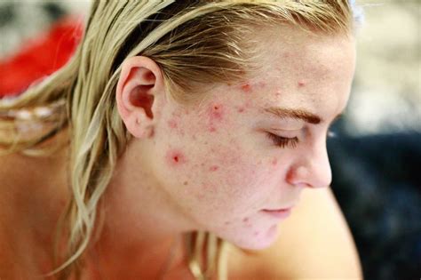 A Complete Guide To Acne Remedies Causes And Types Health Tenfold