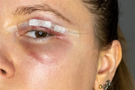 Close Up Woman Eyes After Plastic Surgery Yellow Red Skin Blood