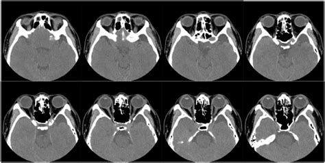 Initial Axial Ct Scans Without Contrast Of Paranasal Sinus Although Ct