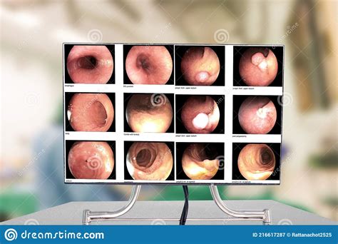 Close Up Endoscopic Examination Of The Stomach On Monitor Out Of Focus