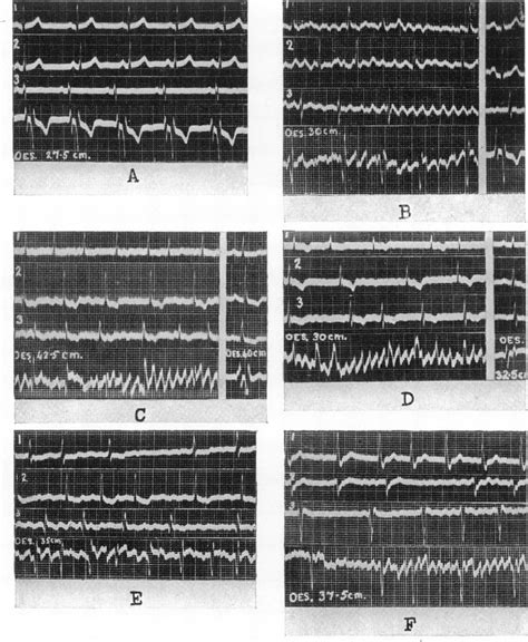 Figure 1 From Cesophageal Electrocardiograms In Auricular Fibrillation