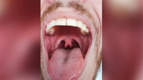 Photo Of Mans Double Uvula Goes Viral Abc News