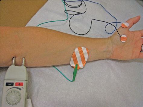 Emg And Nerve Conduction Studies Anesthesia Key