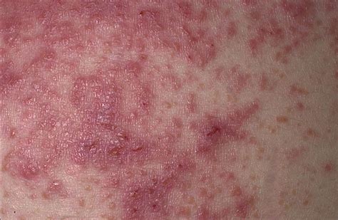 Dermatitis Herpetiformis Celiac Disease Rash Photos Hot Sex Picture