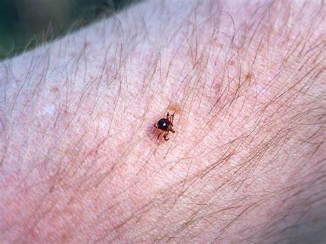 Meat Allergy From Tick Bites Alpha Gal Syndrome And Lone Star Ticks