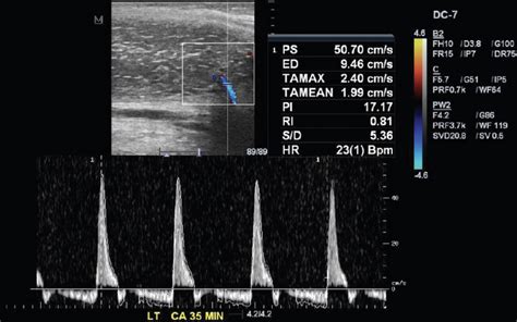 Penile Ultrasound Dysfunction Detection — Fairbanks Urology
