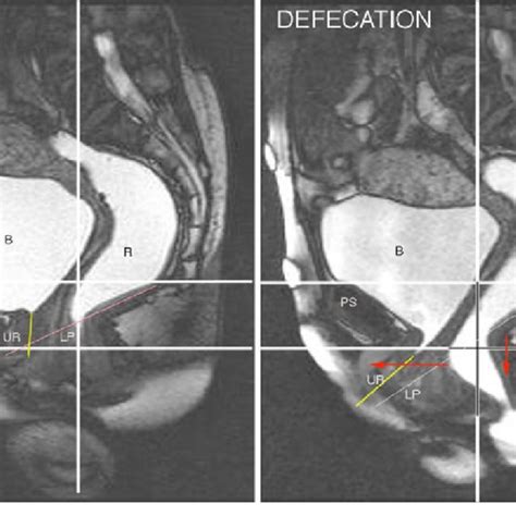 Mri Constipation At Rest The Vertical Bony Reference Line Runs Through Download Scientific