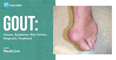 All About Gout Symptoms Diagnosis Treatment