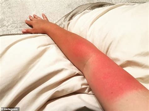 Baked Brits Share Snaps Of Their Disastrous Sunburn Following The Weekend Heatwave Daily Mail