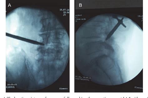 Figure 1 From Lumbar Scoliosis Combined Lumbar Spinal Stenosis And