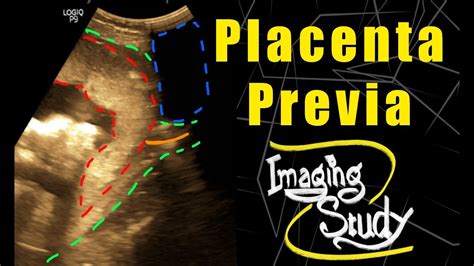 Complete Placenta Previa Ultrasound Case 93 Youtube
