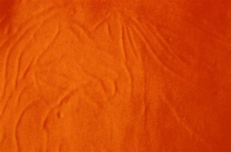 Epithelial basement membrane dystrophy (ebmd), is a disorder of the eye that can cause pain and dryness. Treatment of Epithelial Basement Membrane Dystrophy With ...