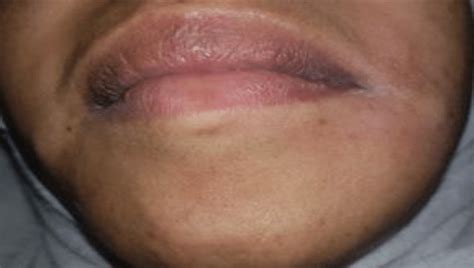 Extraoral Image Showing Swelling On The Left Cheek Region Download