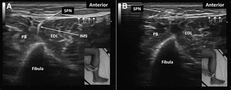 Ultrasound Visualization Of The Superficial Peroneal Nerve In The Mid