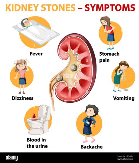 Kidney Stones Symptoms Cartoon Style Infographic Stock Vector Image