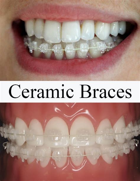 Ceramic Braces Essex Fixed Braces At Hacton Dental Care Hornchurch