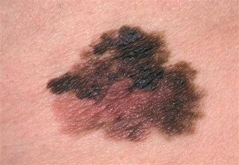 Combination Immunotherapy For Advanced Melanoma Gets Early Approval